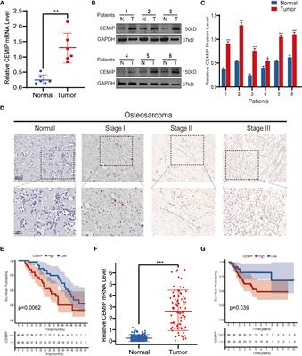 CEMIP Promotes Osteosarcoma Progression and Metastasis Through Activating Notch Signaling Pathway